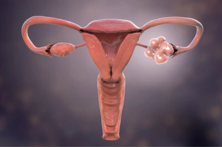 PCOS / PCOD Management (also listed under Women’s Health)